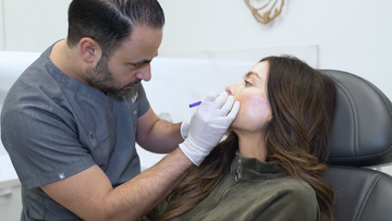 CUPID LIFT® Deep Plane Upper Lip Lift What is the CUPID LIFT