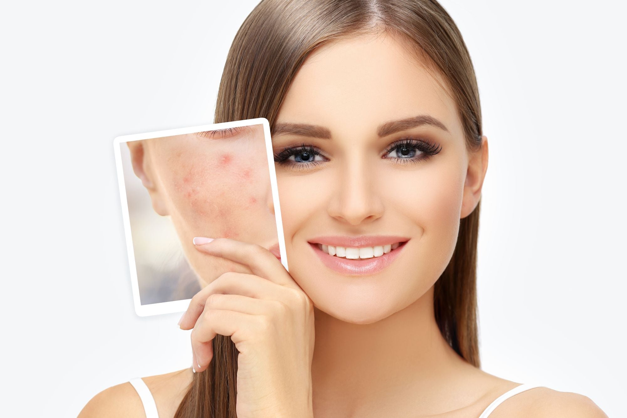 Post-Acne Marks ,Treating Acne Scars.Acne Scar Removal | AviClear® for Skin Rejuvenation 
