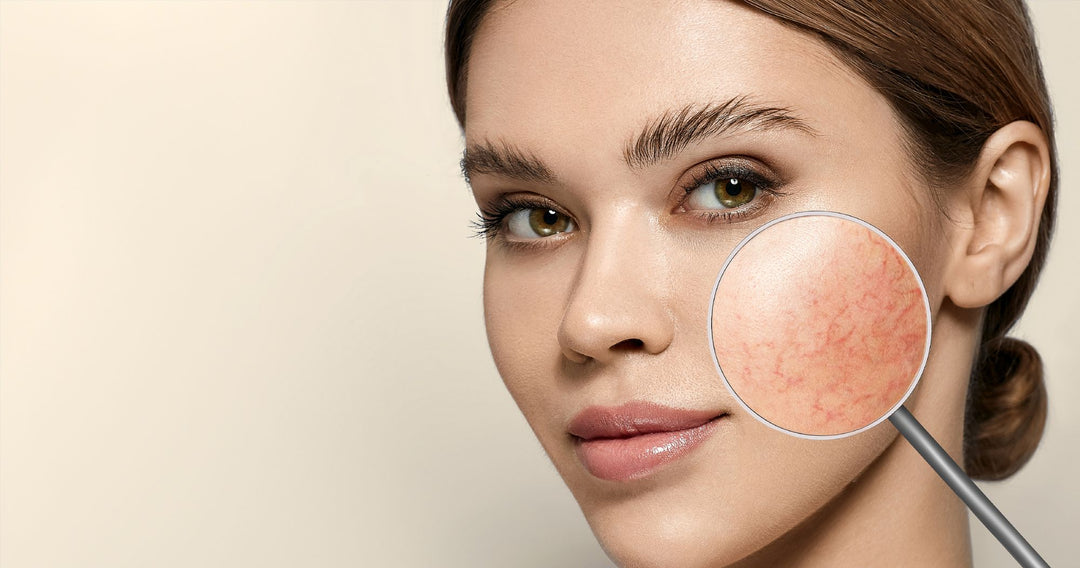 Los Angeles Rosacea Treatment | West Hollywood Effective Face Redness  Treatment – CUPID LIPS™